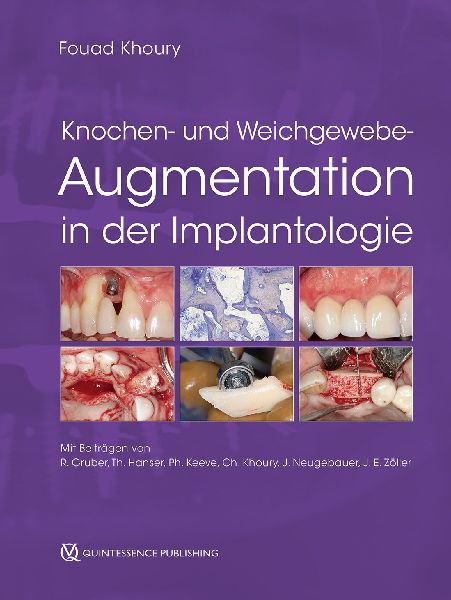 Knochen- und Weichgewebeaugmentation in der Implantologie