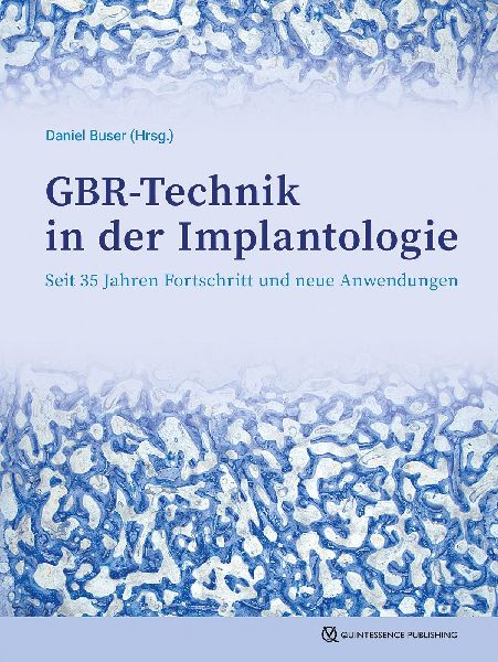 GBR-Technik in der Implantologie